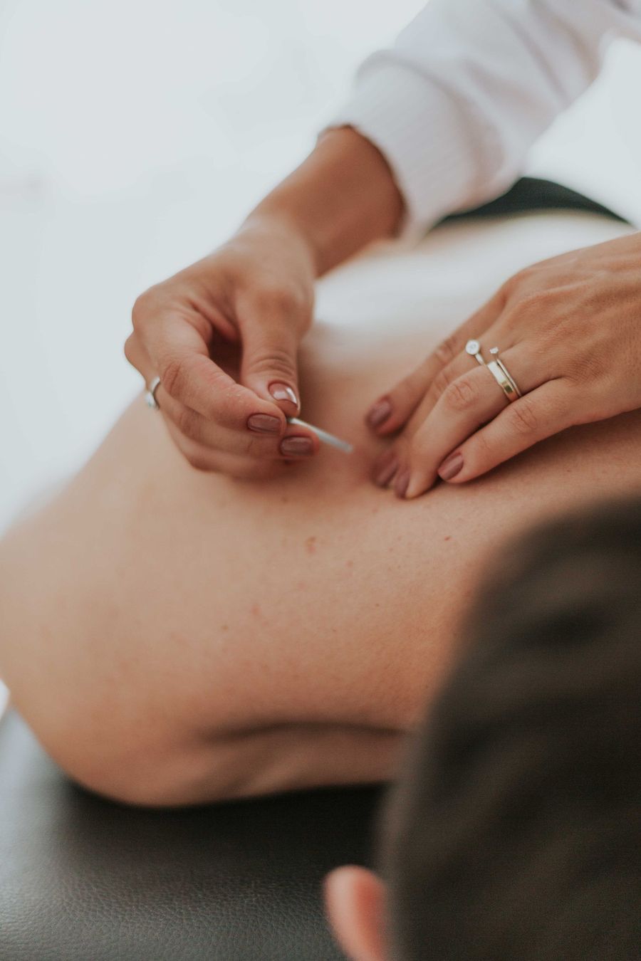Acupunturista aplicando agujas en la espalda durante una sesión