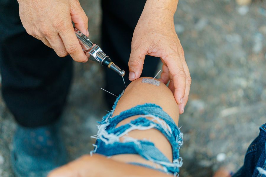Agujas de acupuntura en la rodilla con un estimulador